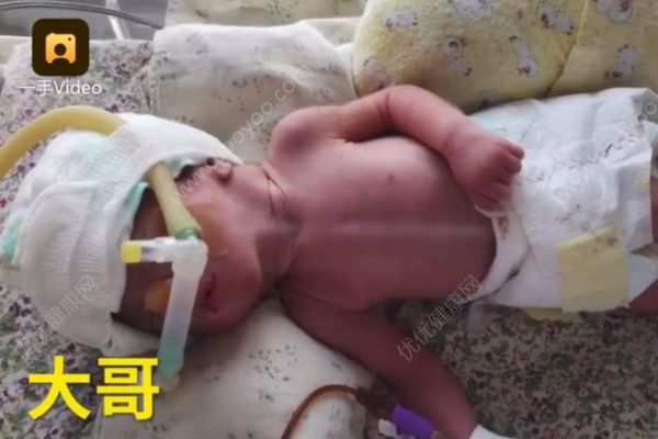 女子自然受孕产下龙凤4胞胎，概率仅为70万分之一(2)