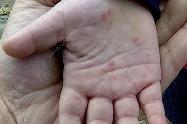 女婴手臂一夜间变黑坏死生命垂危，原是被细菌吃掉了！(3)