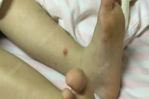 西安一幼儿园多人感染手足口病，家长质疑园方隐瞒(1)