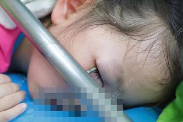 3岁女童被铁钩戳进眼睛，带着一截钢管送医(2)