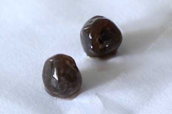 男孩贪杯珍珠奶茶致胆囊炎，珍珠胃中堆成“小山”(3)