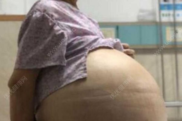 69岁大妈患妇科肿瘤肚鼓如球，医生抽出30多升囊液(1)