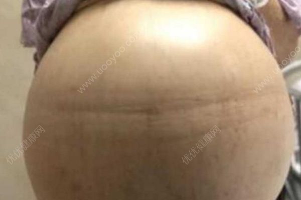 69岁大妈患妇科肿瘤肚鼓如球，医生抽出30多升囊液(2)