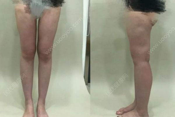 23岁女子花1万5做腿部吸脂术，半年后腿上全是坑(1)