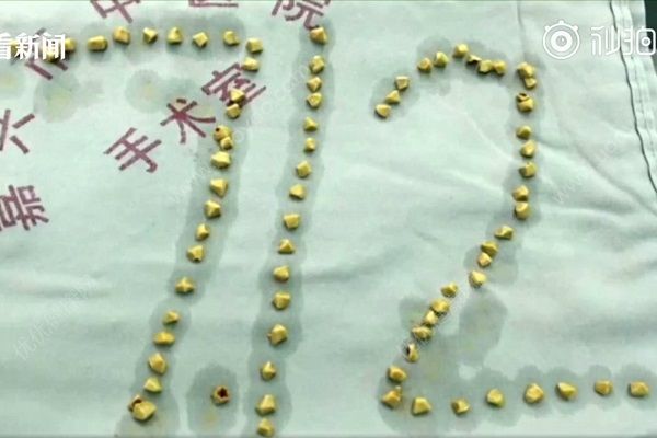 每天吃个鹅蛋，两年后体内取出80多颗结石(1)