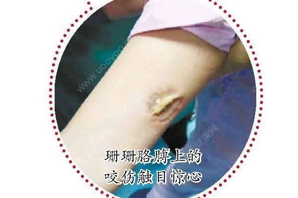 护士被病人咬胳膊3分钟，什么情况下要打破伤风(2)