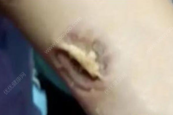 护士被病人咬胳膊3分钟，什么情况下要打破伤风(3)