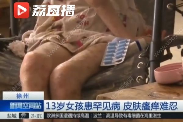 女孩患罕见病最怕热，家贫买不起空调只靠奶奶背起来回走(3)