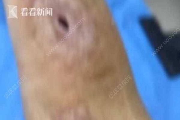 男子杀鱼时不小心划伤手指，几个月后右手手臂被