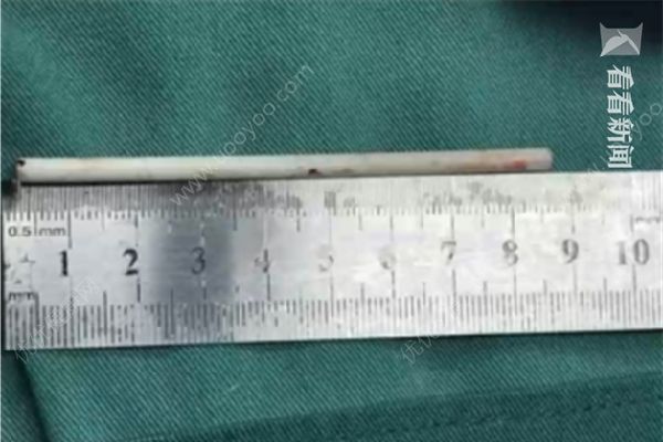 7岁男孩腹痛近1周，医生取出8厘米棒棒糖棍子(1)