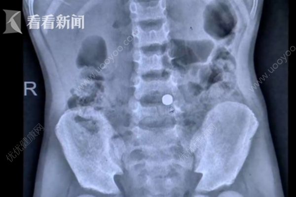 7岁男孩腹痛近1周，医生取出8厘米棒棒糖棍子(2)