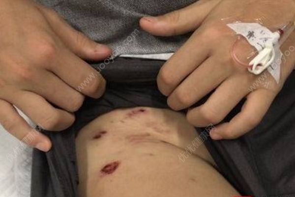 未栓绳德牧咬伤13岁少年，狗主人被拘留10日罚500元(2)