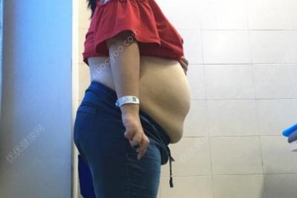 女学生肚子内藏巨大包块，囊液相当于24瓶矿泉水(1)